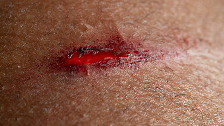 Behandeling Skin tear